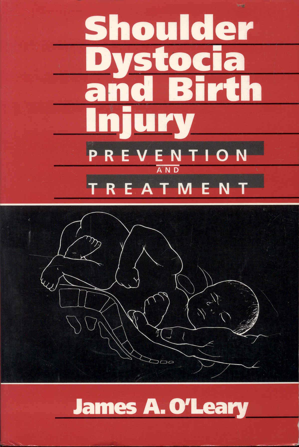 Shoulder Dystocia Birth Injury Prevention & Treatment Guide - Expert Tips for Safe Delivery & Newborn Care | For OBGYNs, Midwives & Expecting Parents