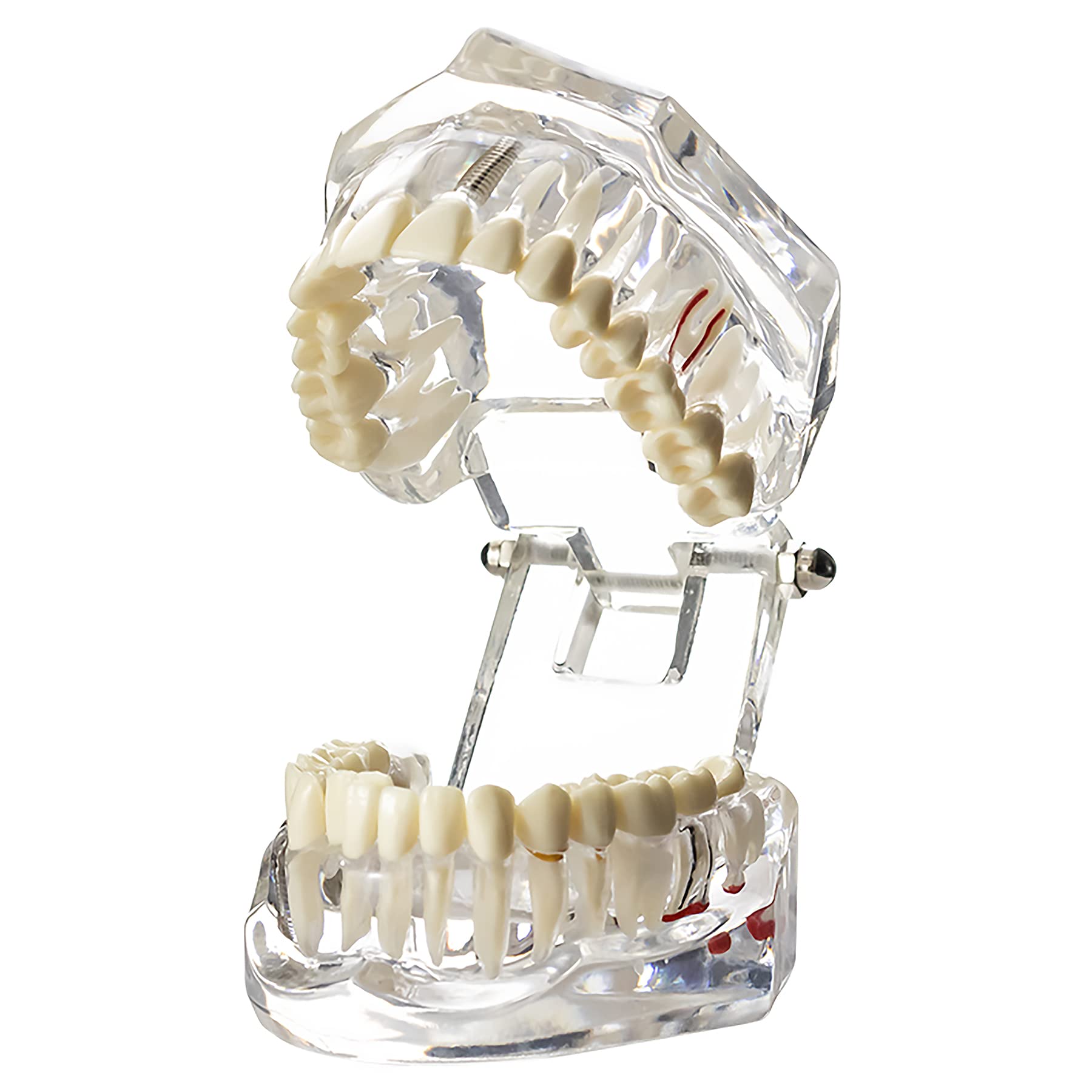 Dental Implant Model Typodont Teeth - Clear M2001 for Dental Restoration, Oral Pathology Study & Teaching | Perfect for Dental Students, Professionals & Clinical Demonstrations