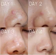 Yanhee Acne Cream for Acne Treatment - Travel Size (7g x 6 Sachets) - Clear Skin Solution for Face & Body - Perfect for Travel, Gym & Daily Skincare Routine