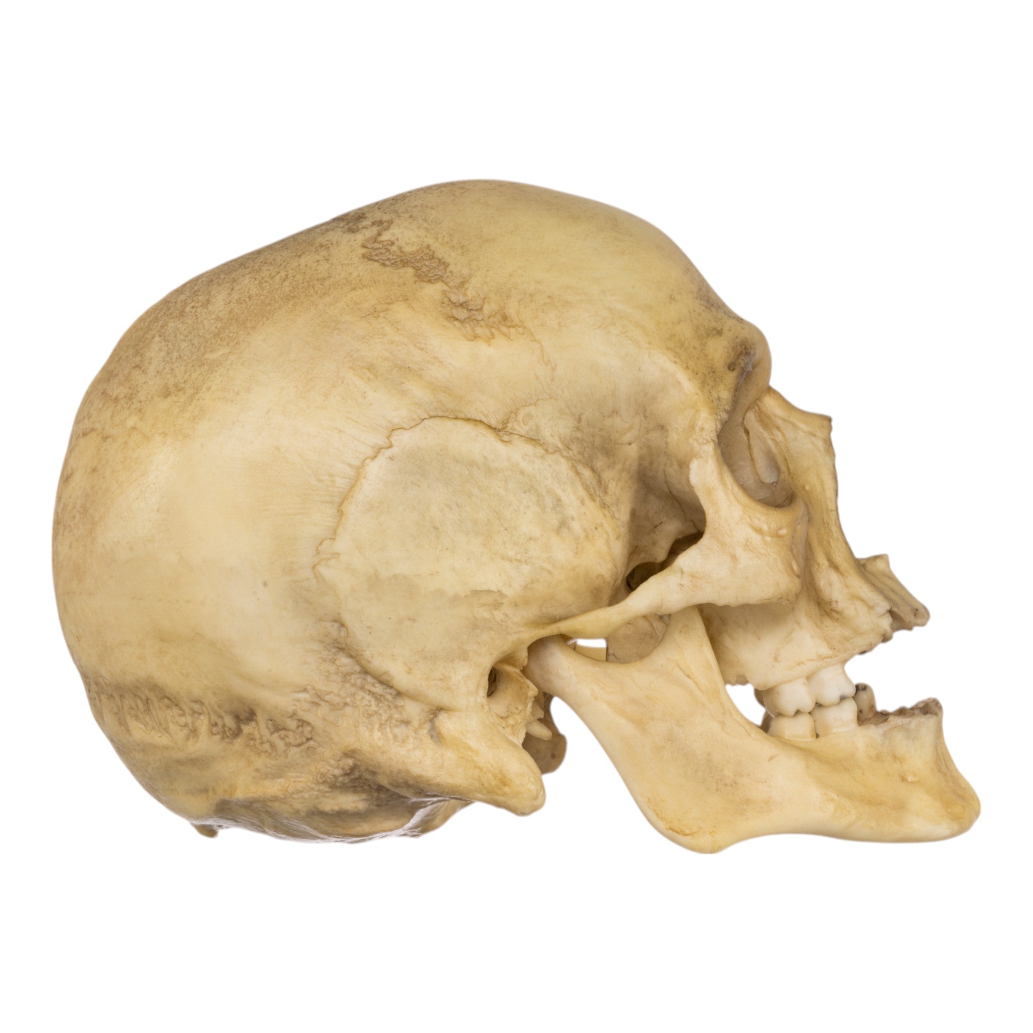 Realistic Replica Human Male Skull with 32 Caliber Gunshot Wound - Perfect for Medical Training, Forensic Studies, and Halloween Decorations