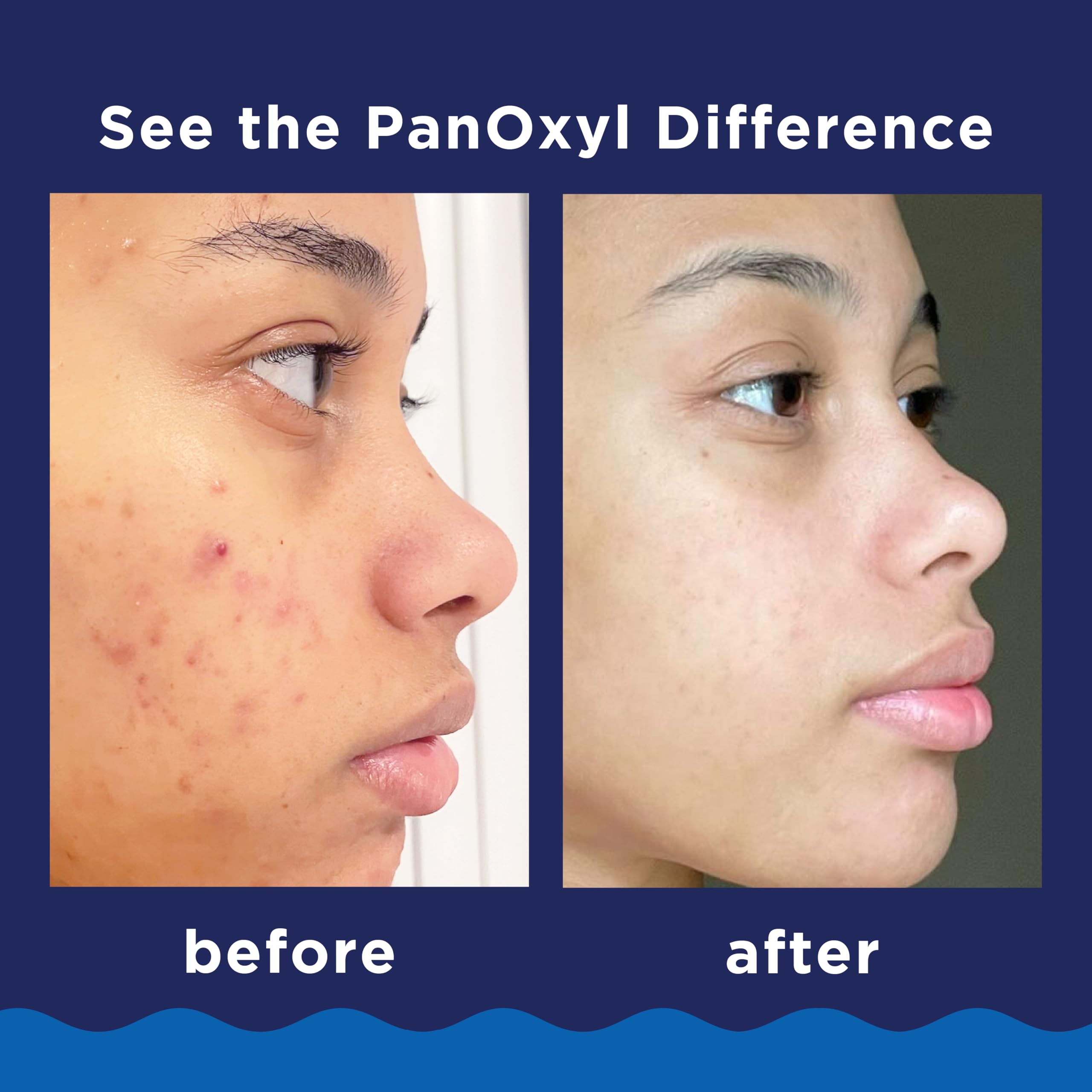 PanOxyl Acne Foaming Wash 10% Benzoyl Peroxide Maximum Strength Antimicrobial Face Cleanser - 3 oz Travel Size for Acne-Prone Skin - Perfect for Gym, Travel & Daily Skincare Routine