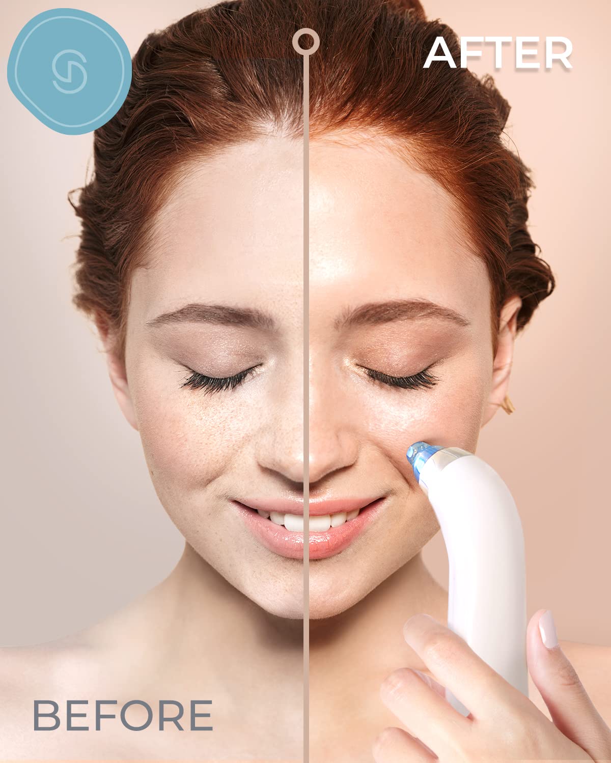 Blackhead Remover Vacuum Tool - Deep Pore Cleaner for Acne & Blackheads - Facial Care at Home