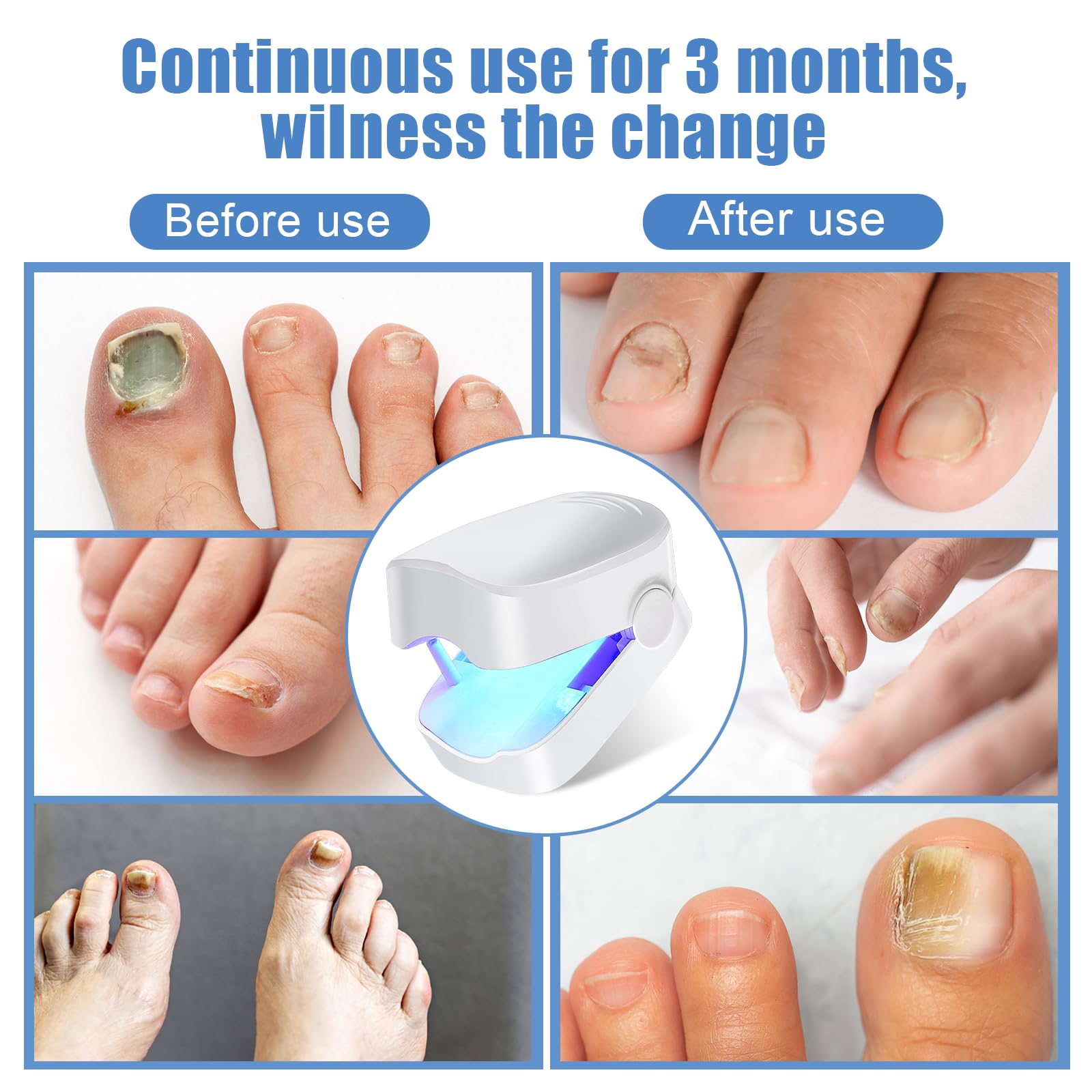 Best Nail Fungus Laser Treatment Device with LED Light - FSA & HSA Eligible for Toenail & Fingernail Fungal Infections - Effective Home Remedy for Healthy Nails