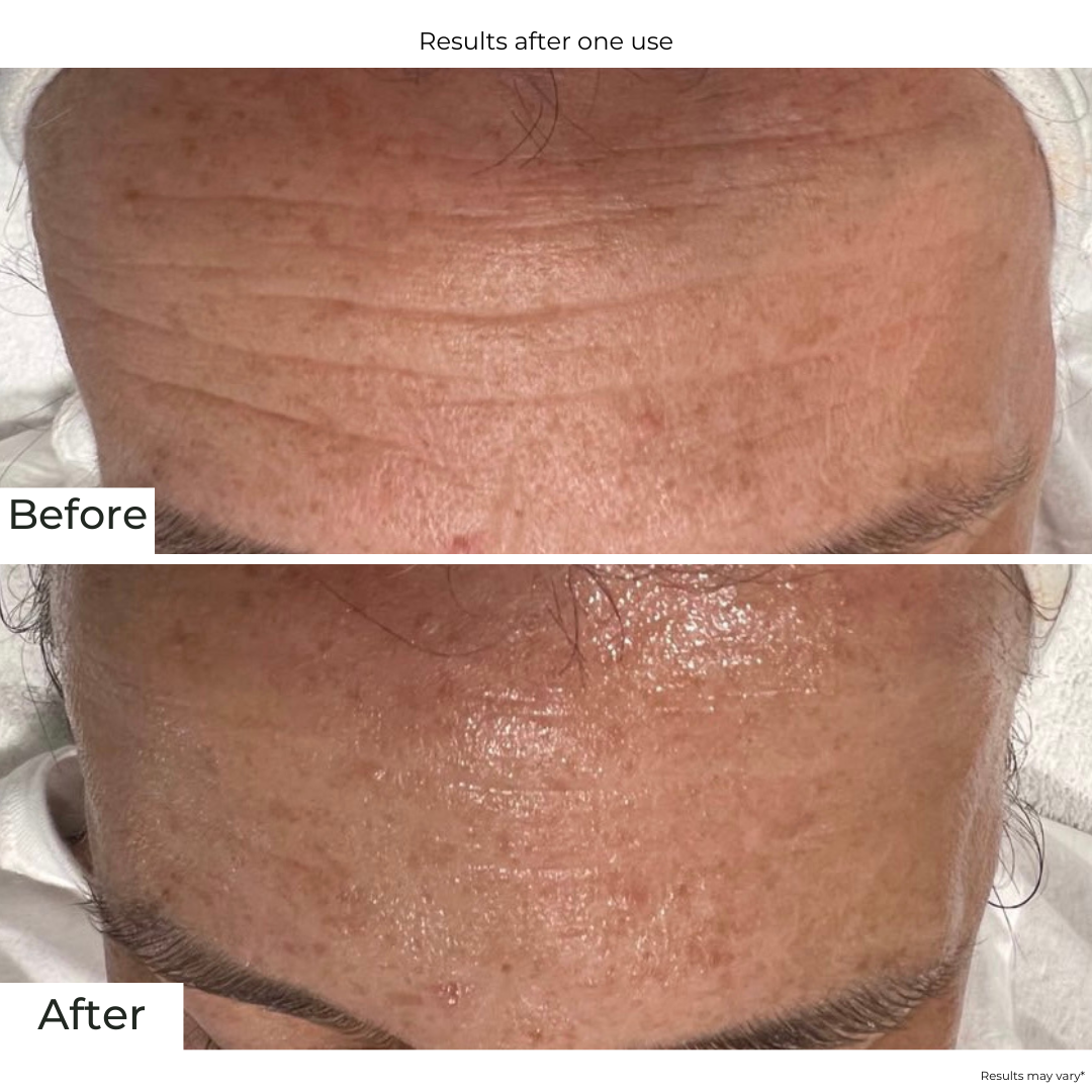 Best Hyaluronic Acid Serum for Face - Hydrating & Anti-Aging Skincare - Perfect for Dry Skin & Wrinkle Reduction
