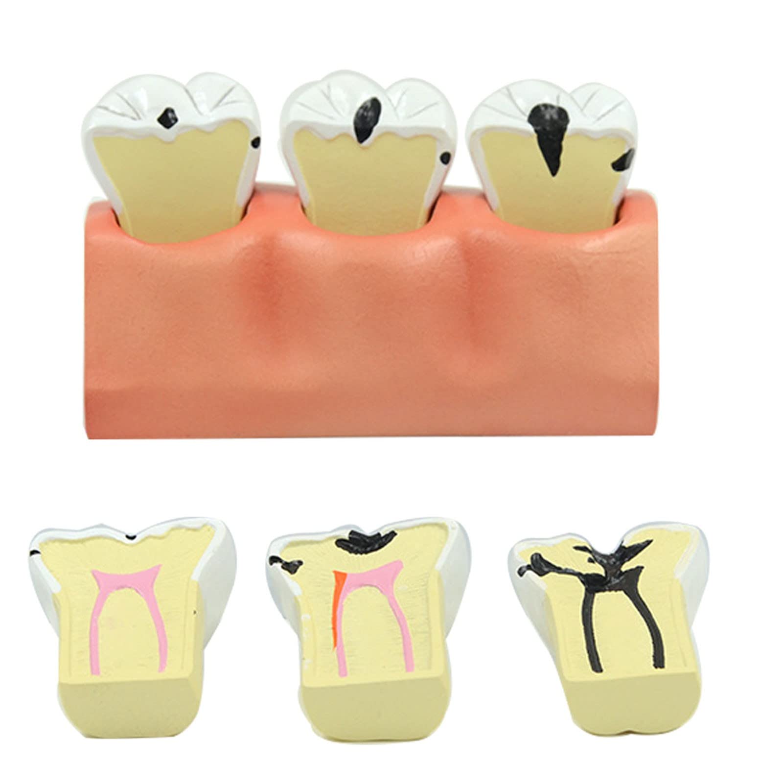 **Removable Dental Teeth Model - Caries & Tooth Decay Demonstration Kit for Dental Education, Teaching & Oral Health Training - Perfect for Dentists, Students & Classroom Learning**    *(Ideal for dental schools, clinics, patient education & hands-on training!)*