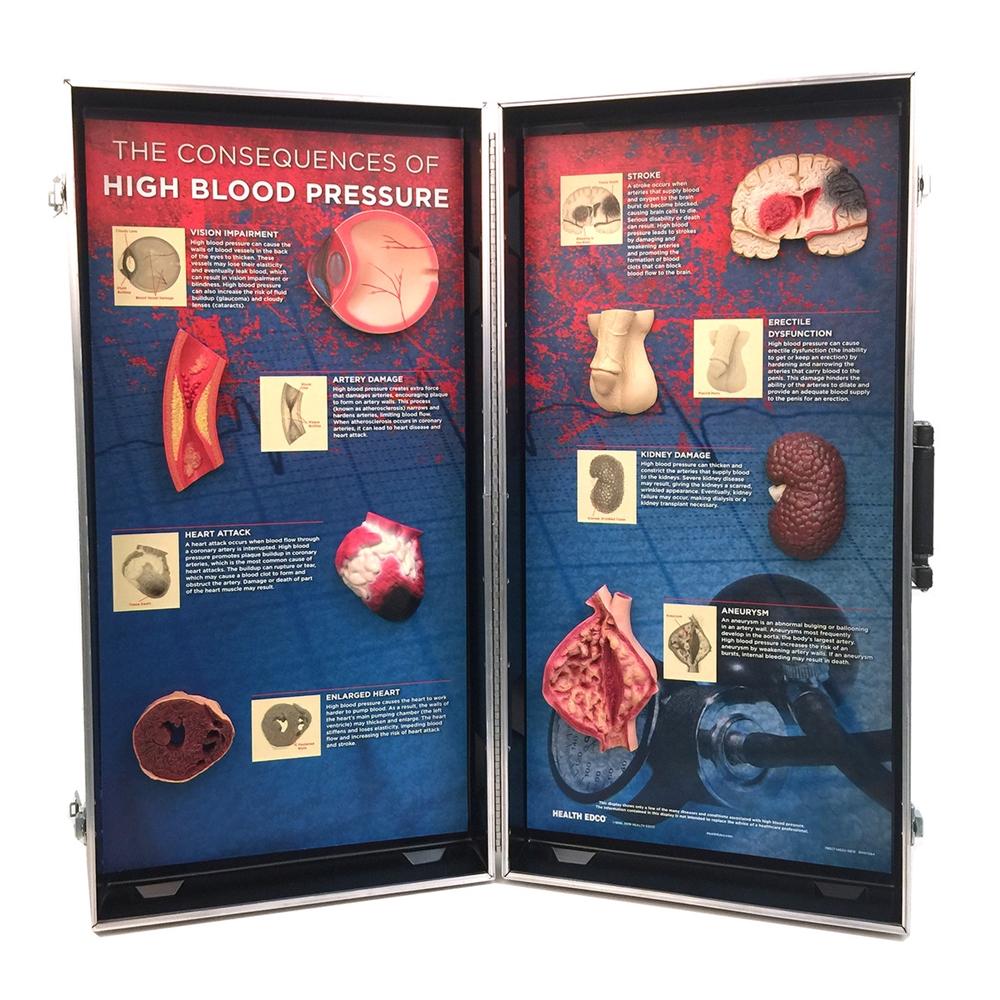 3D Display of High Blood Pressure Consequences - Educational Medical Model for Doctors & Students | Perfect for Health Classrooms & Medical Training