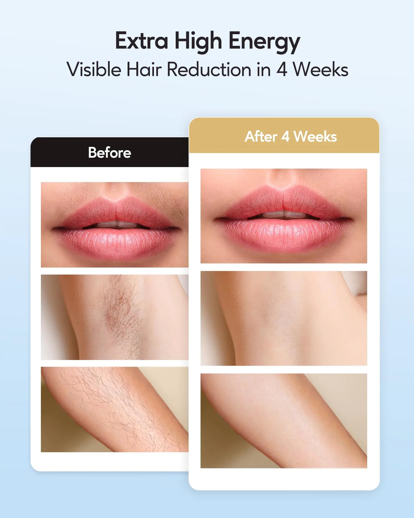 INNZA IPL Laser Hair Removal Device - 999,999 Flashes Permanent Hair Remover with Ice Cooling System for Painless At-Home Hair Removal - Perfect for Legs, Underarms, Bikini Line & Full Body Smooth Skin Care
