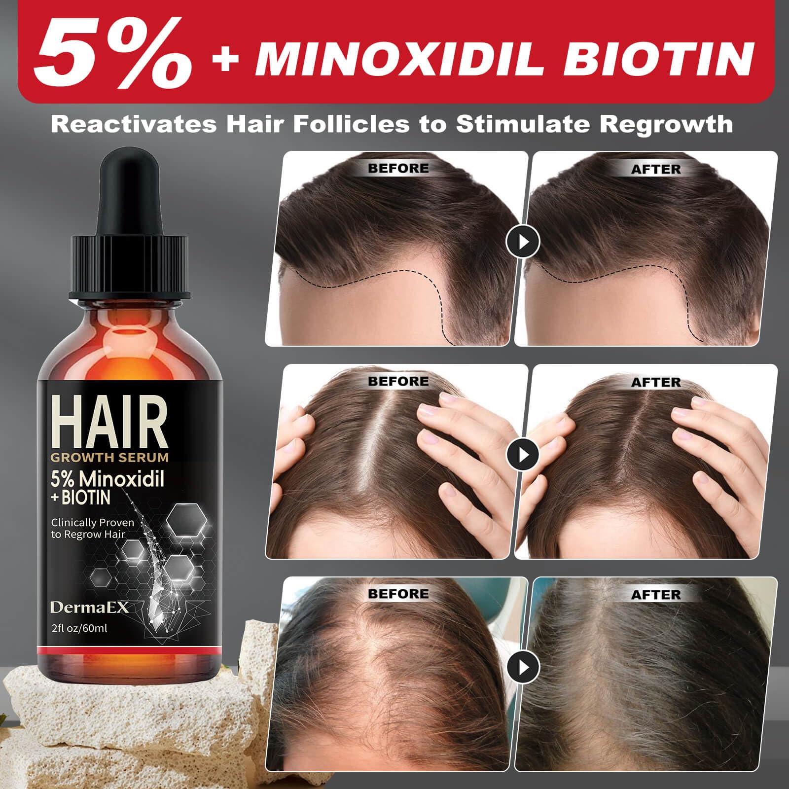 5% Minoxidil & Biotin Hair Growth Serum for Women & Men - Hair Loss Treatment & Regrowth Solution for Thicker, Longer, Fuller Hair (2 Fl Oz) - Perfect for Daily Use at Home or Salon Treatments