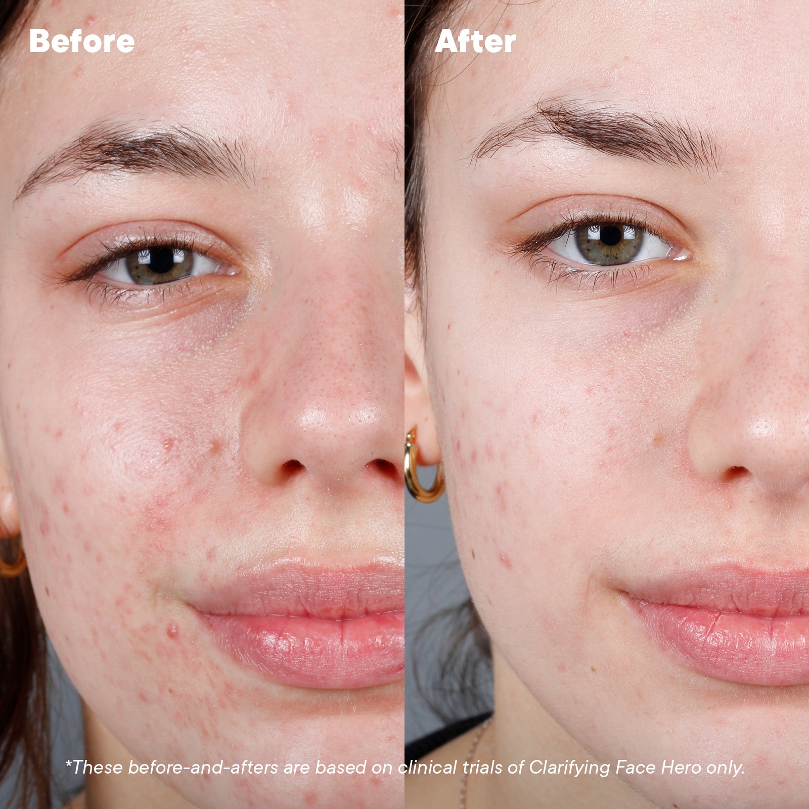 Best Acne Treatment Products to Beat Breakouts - Clear Skin Solutions for Teens & Adults | Perfect for Daily Skincare Routine