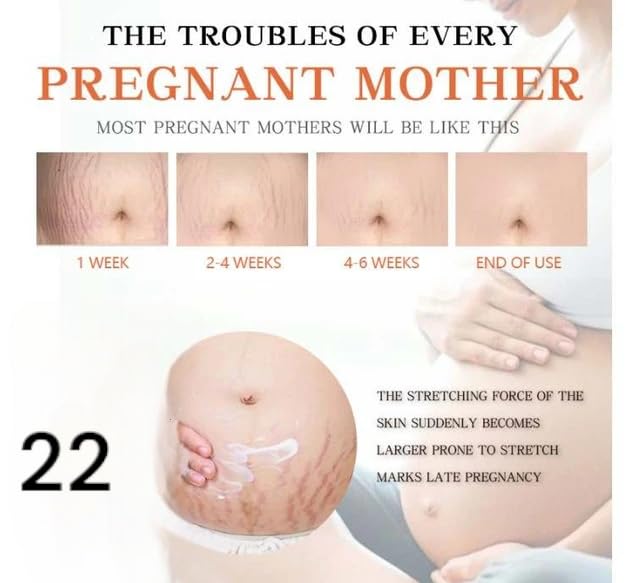 Best Stretch Mark Removal Cream for Men & Women - Pregnancy Safe, Scar & Wrinkle Treatment | Postpartum Care & Skin Repair