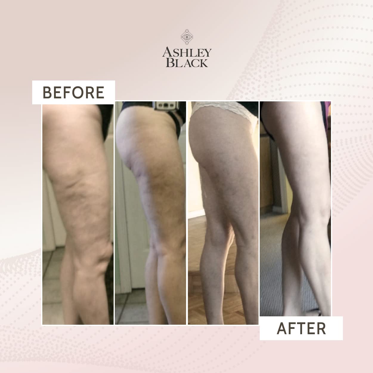Ashley Black Anti-Cellulite Massage Kit - FDA Registered #1 Best Selling Cellulite Treatment Tools with Small & Large Fascia Claws for Surface & Deep Tissue Therapy | Perfect for Home Spa, Post-Workout Recovery & Body Contouring