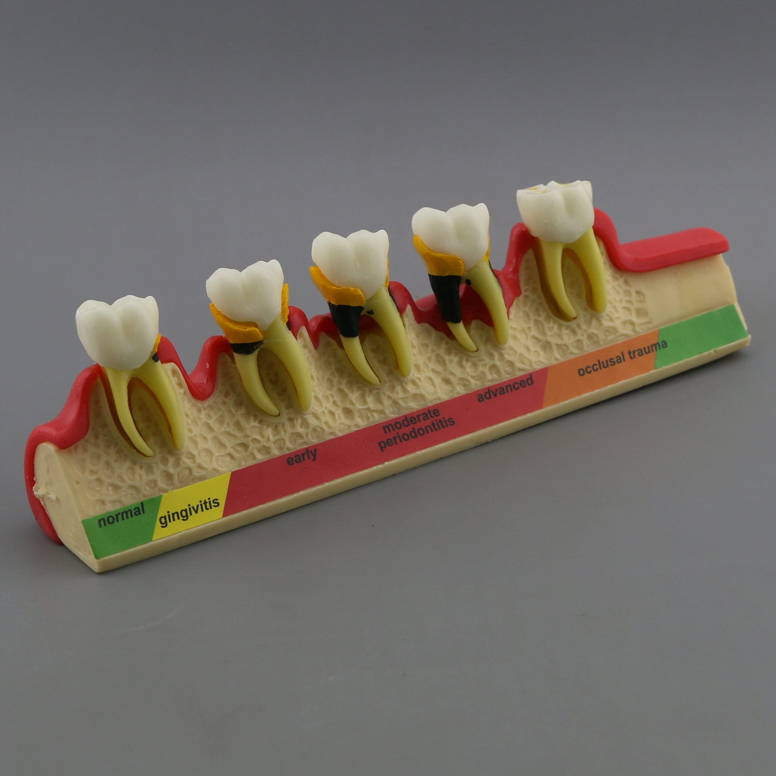 Dental Typodont Teeth Model for Adults & Children - Pathological Demonstration for Teaching & Studying (M4010) | Ideal for Dental Schools, Training & Clinical Practice