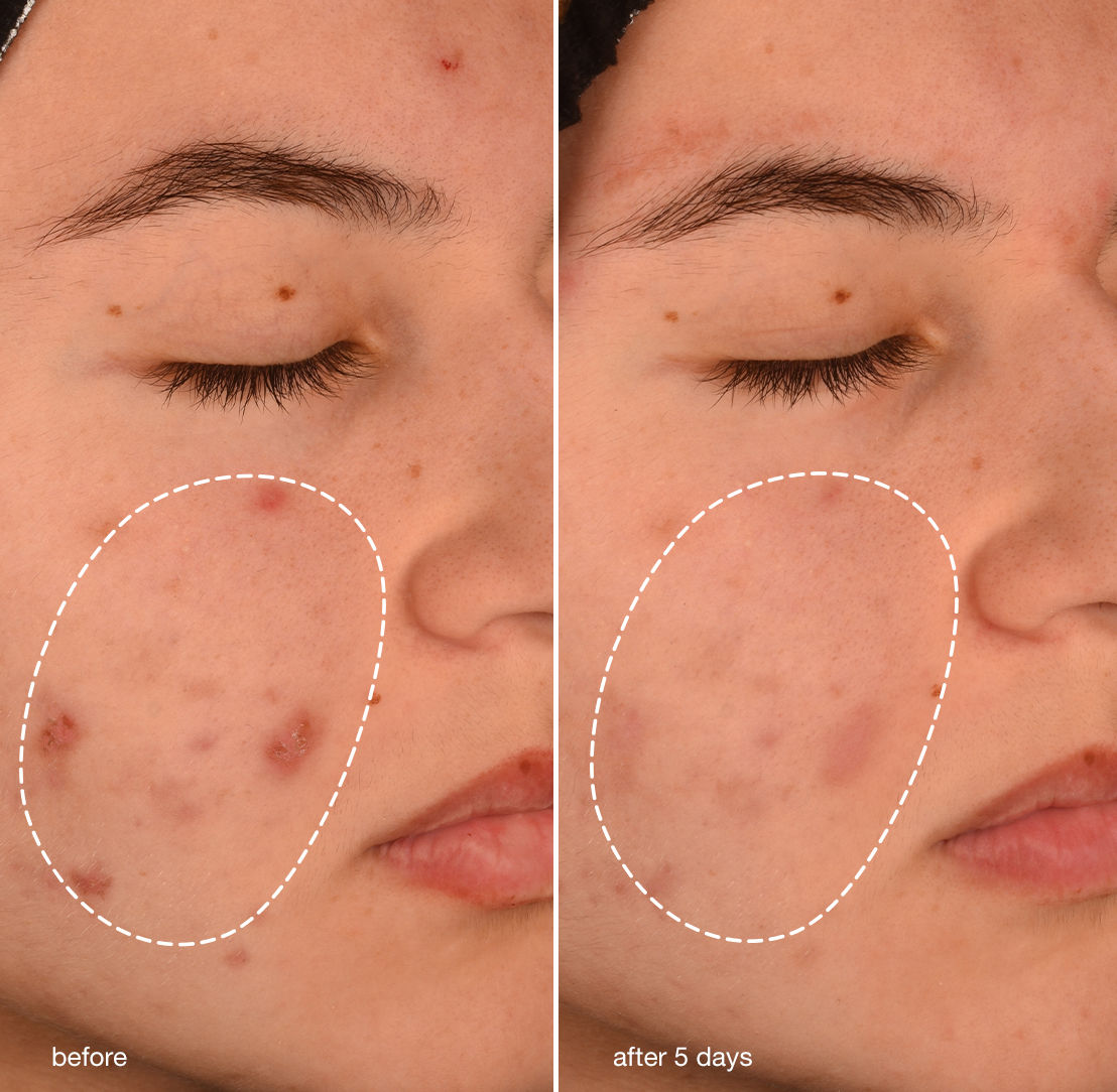 Best Acne Biotic Moisturizer for Clear Skin - Probiotic Face Cream for Acne-Prone Skin - Daily Hydration & Blemish Control - Perfect for Morning & Night Skincare Routine