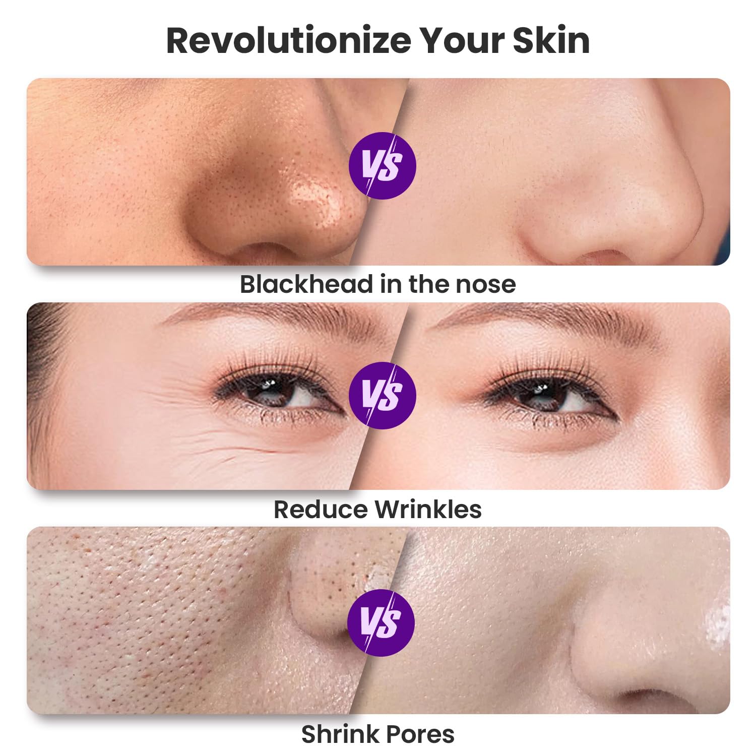 Professional 3-in-1 Microdermabrasion Machine - Portable Facial Exfoliator for Skin Rejuvenation, Blackhead & Acne Treatment - Perfect for Home Spa & Salon Use