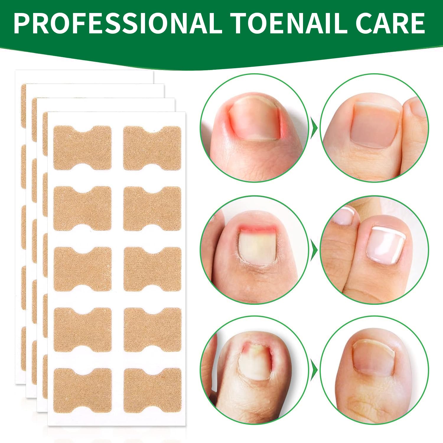 50 Pcs Ingrown Toenail Corrector Patches - No Glue Breathable & Painless Nail Correction Treatment, Stays on Securely for Quick Repair | Ideal for Athletes, Runners & Daily Comfort