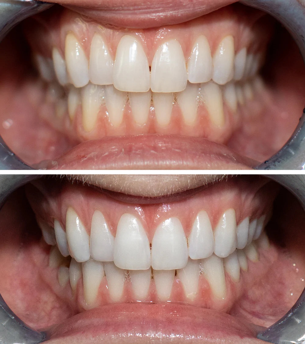 Natural Hydroxyapatite & Charcoal Teeth Whitening Toothpaste - Remineralizing & Stain Removal for Sensitive Teeth - Perfect for Daily Oral Care & Bright Smile