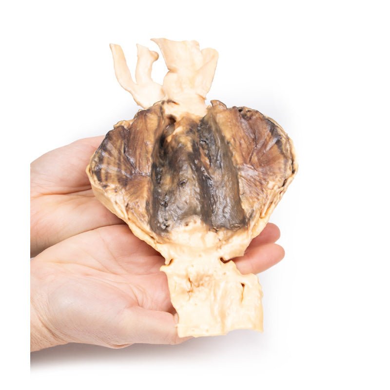 3D Printed Abdominal Aortic Aneurysm Model - Medical Training & Education Tool for Cardiovascular Studies - Perfect for Doctors, Students & Healthcare Professionals