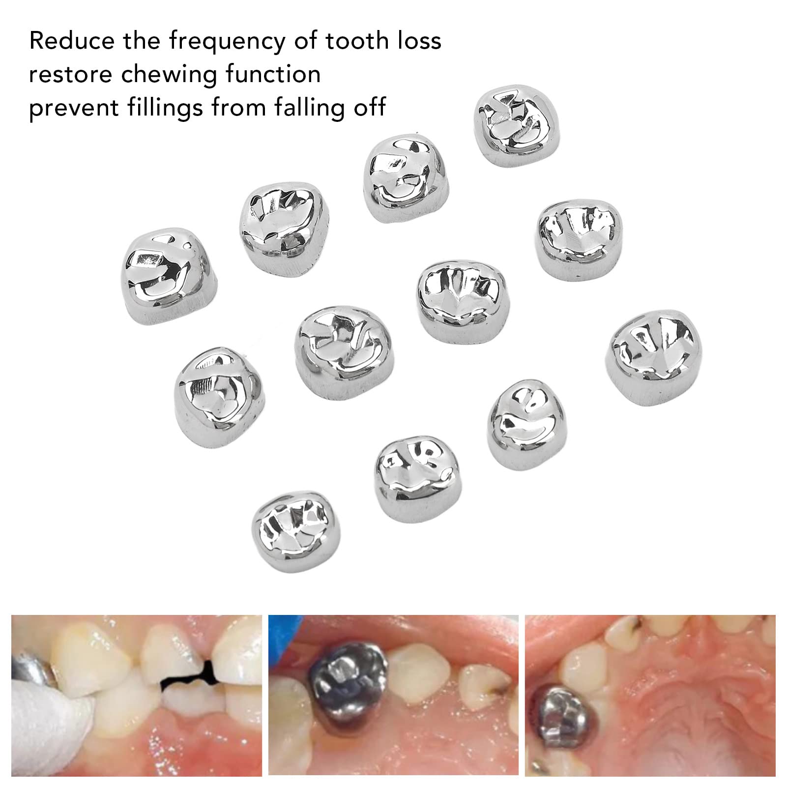 Stainless Steel Dental Crowns for Teeth - Anti-Rust Metal Molar Caps for Tooth Loss Prevention | Dental Clinic & Hospital Use