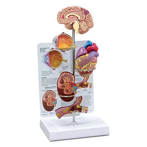 Hypertension Model Set - Human Body Anatomy Replica Showing Effects of High Blood Pressure | Medical Education Tool for Doctors Office & Classroom | GPI Anatomicals | Perfect for Medical Training & Patient Education
