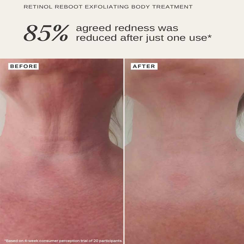 Alpha H Retinol Reboot Exfoliating Body Treatment with 1% Encapsulated Retinol - Anti-Aging Body Lotion for Smooth, Glowing Skin - Perfect for Nighttime Skincare Routine & Dry Skin Care