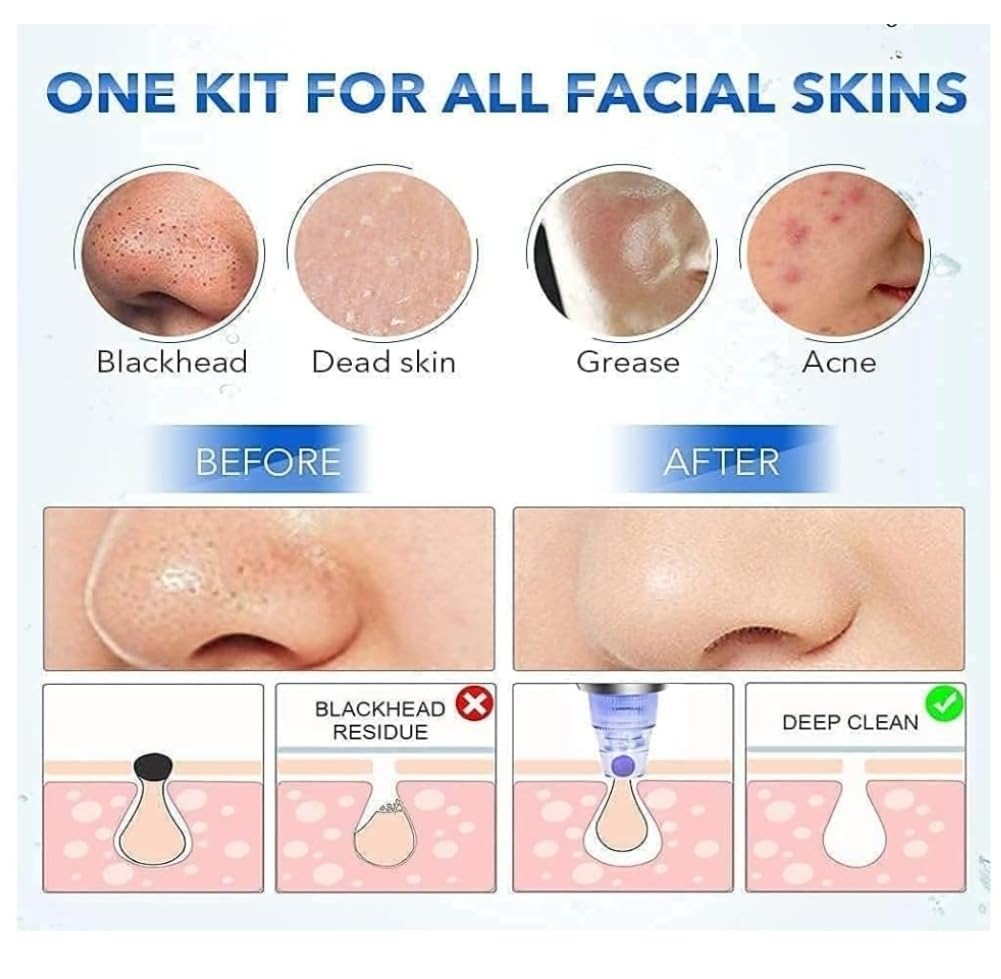 Blackhead Remover Vacuum Kit - 4-in-1 Multi-Function Pore Cleaner for Acne & Pimple Removal, Skin Care Tool for Beautiful Complexion (White) | Perfect for Daily Facial Cleansing & Spa Treatments