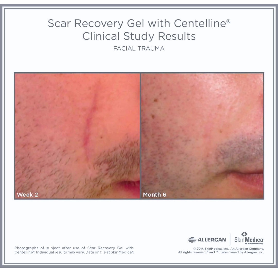 SkinMedica Scar Recovery Gel for Face & Body - Advanced Scar Treatment Gel for Post-Surgery, Acne, Burns & Wounds - Dermatologist Recommended Scar Removal Cream for Visible Results