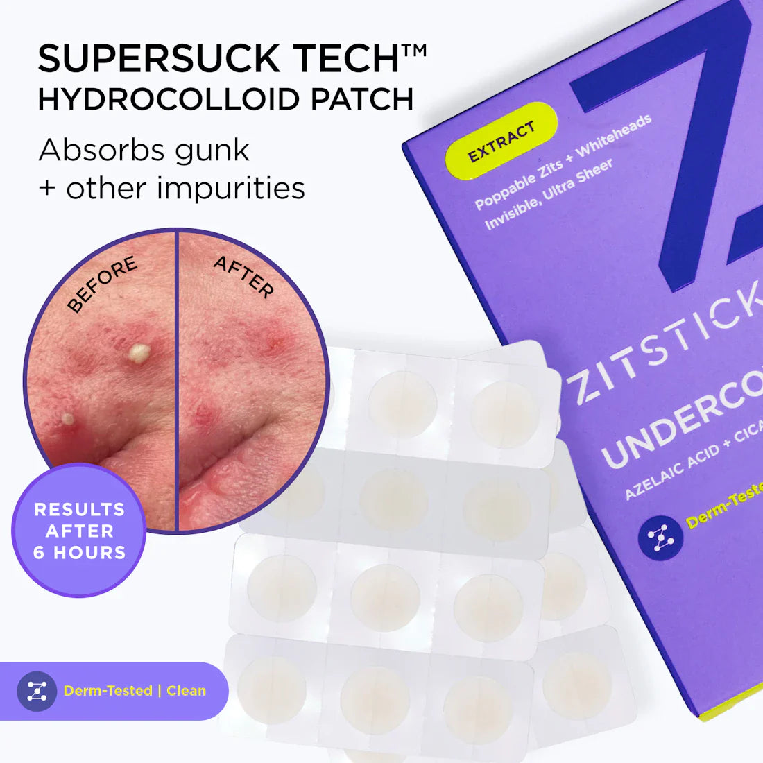 ZitSticka Undercover Acne Patches - Invisible Pimple Treatment for Clear Skin | Use for Overnight Spot Treatment, On-the-Go Blemish Care, and Post-Breakout Healing
