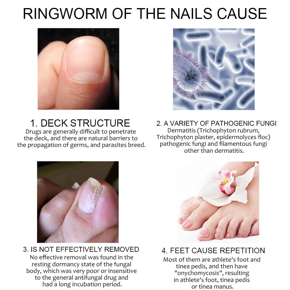 Allbestaye Fungal Nail Repair Pen - Effective Treatment for Onychomycosis & Paronychia, Restores Healthy Nails Damaged by Fungus | Anti-Fungal Nail Infection Solution for Toenails & Fingernails | Perfect for Daily Nail Care & Salon Use