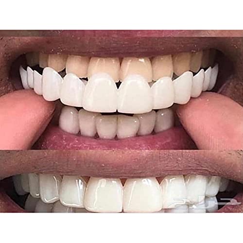 New Snap Smile Dental Upper False Teeth Cover - Perfect Smile Veneers for Comfort Fit & Flexible Denture Braces | Instant Teeth Whitening Solution for Gaps, Stains & Missing Teeth | Ideal for Daily Wear, Special Occasions & Confidence Boosting