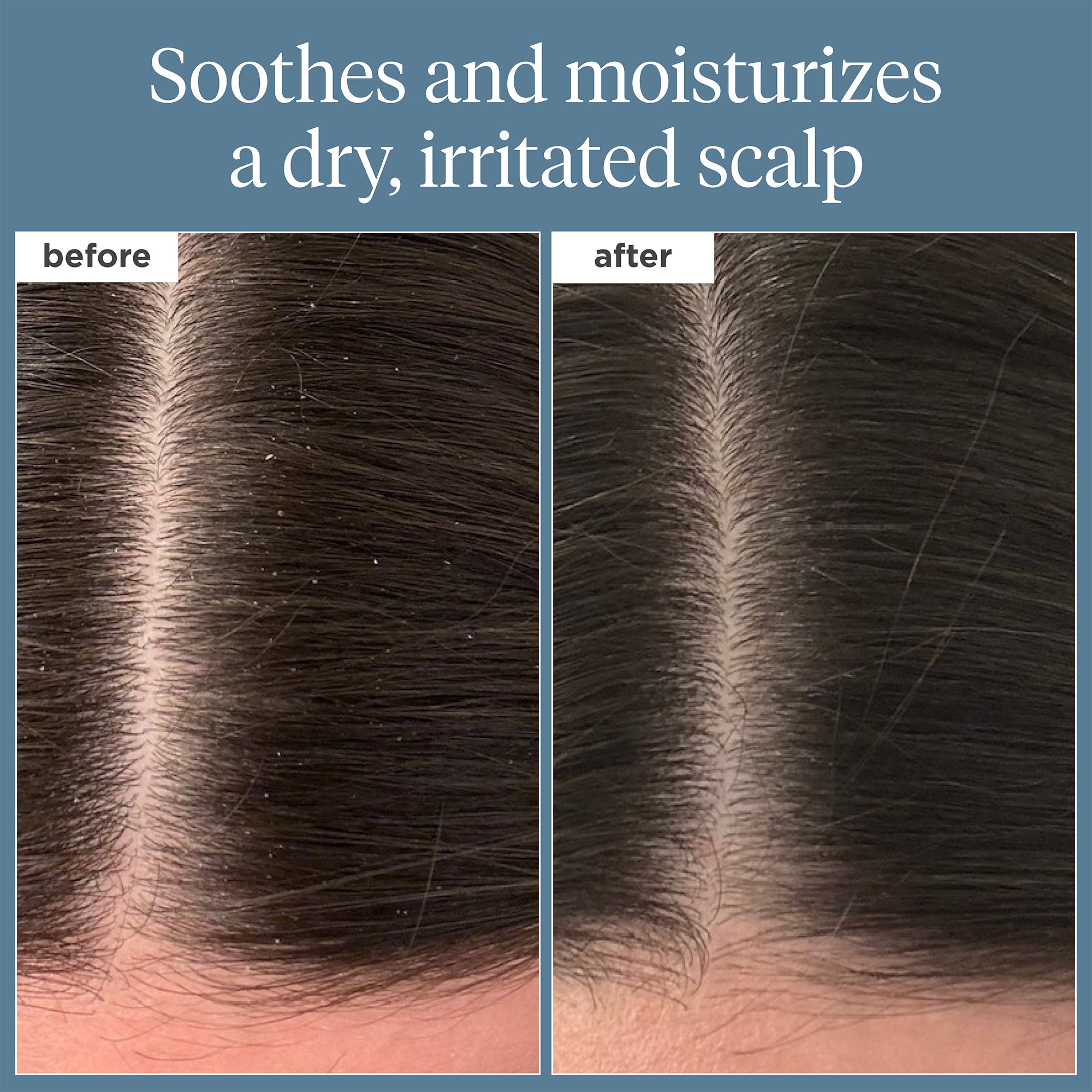 Scalp Revival Rosemary Pre Wash Oil for Hair Growth & Scalp Care - Natural Hair Treatment for Dry Scalp, Dandruff & Itch Relief | Perfect for Pre-Shampoo Routine & Deep Conditioning