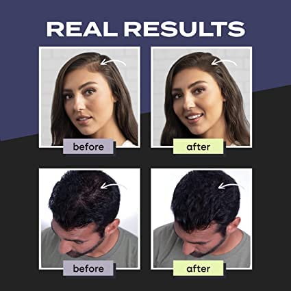 Natural Dark Brown Hair Building Fiber Powder - 25g Thickening Fibers for Hair Loss Treatment & Concealer Refill | Instant Volume Boost for Thinning Hair, Bald Spots & Receding Hairlines | Perfect for Daily Use, Special Occasions & Confidence Building
