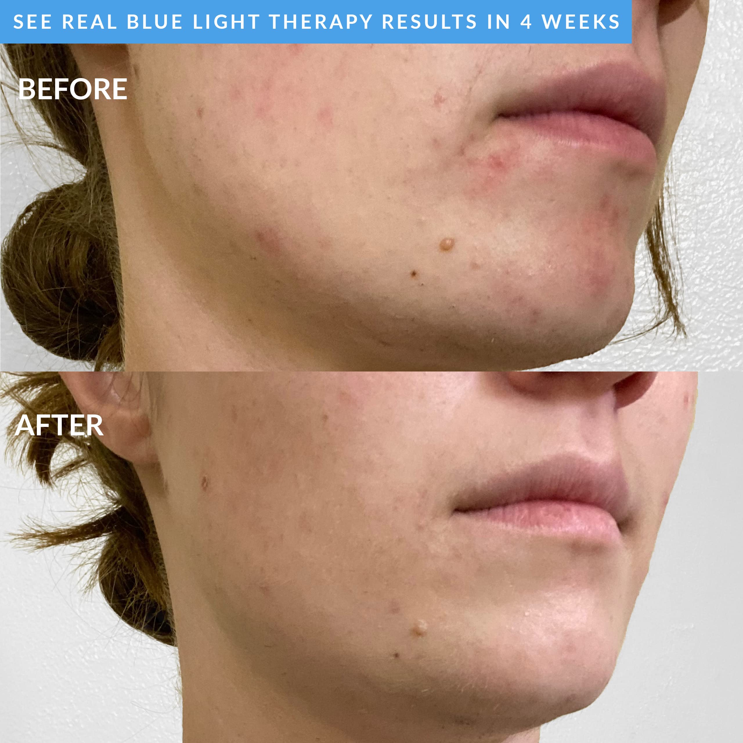 PMD Clean Acne Smart Facial Cleansing Device - Waterproof Silicone Brush with Blue Light Therapy for Acne Treatment | SonicGlow Vibration Technology to Clear Pores, Blackheads & Blemishes | Perfect for Daily Skincare Routine & Travel-Friendly Beauty Device