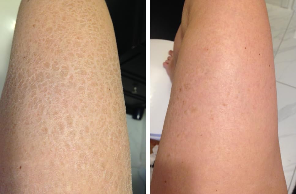 G16 Skin Repair Cream - Intensive Moisturizing Lotion for Very Dry Skin & Ichthyosis Treatment | Dermatologist Recommended for Eczema, Psoriasis & Cracked Skin Care
