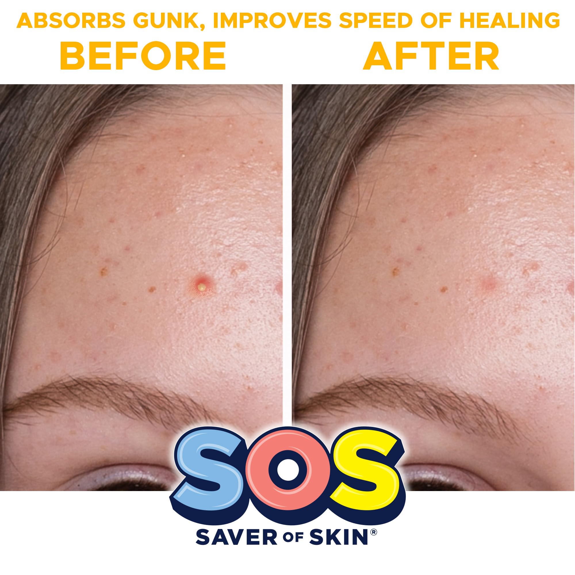 **Fast-Acting Hydrocolloid Acne Patches - SOS SAVER OF SKIN™ Blemish Patches for Pimples, Zits & Breakouts | Absorbs Fluids, Latex-Free, Vegan (40 Count, Transparent) | Perfect for Overnight Acne Treatment & Daily Skin Care**