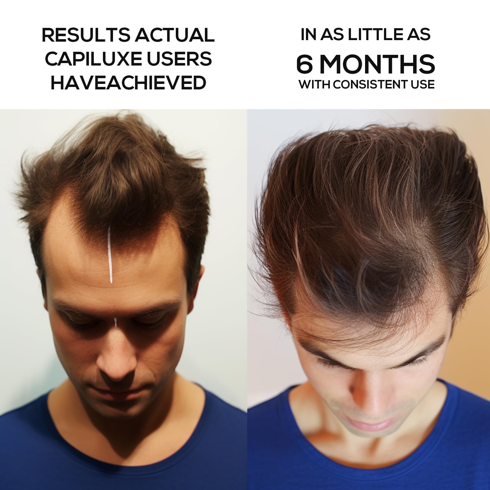 Laser Therapy Cap for Hair Regrowth - FDA Cleared Hair Growth System for Men & Women - Red Light Therapy Device for Thinning Hair & Baldness - Use at Home for Daily Hair Care Routine