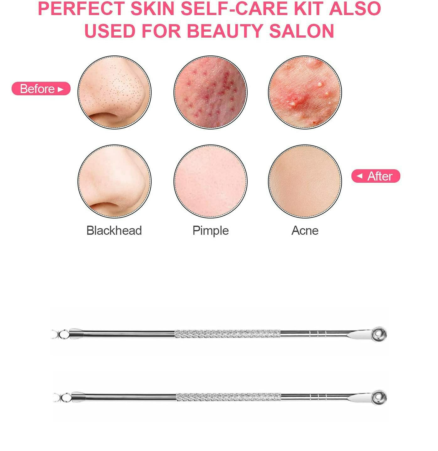Professional Blackhead Remover Tool - Stainless Steel Acne Treatment & Pimple Popper for Comedone, Whitehead & Blemish Extraction (2-Pack) with Anti-Slip Handle - Perfect for Home Skincare & Facial Treatment
