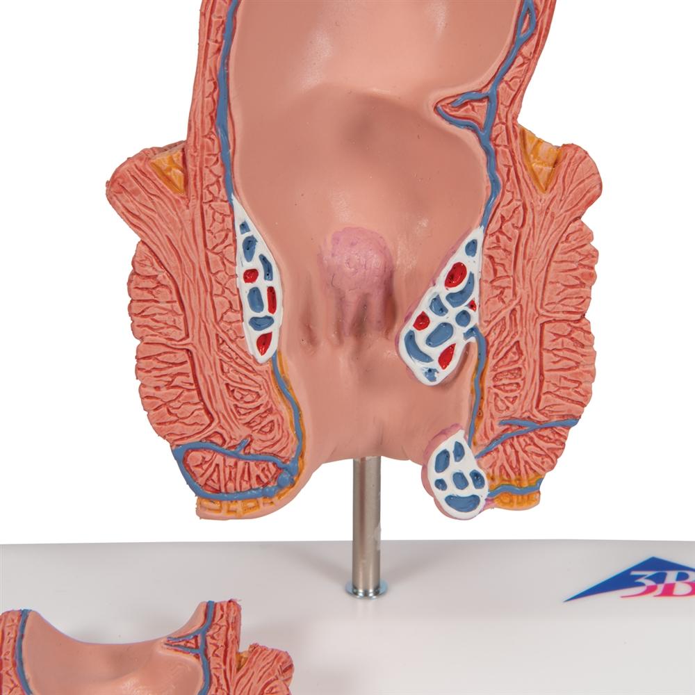 Premium Hemorrhoid Anatomy Model for Medical Training & Patient Education – Ideal for Doctors, Nurses & Healthcare Professionals