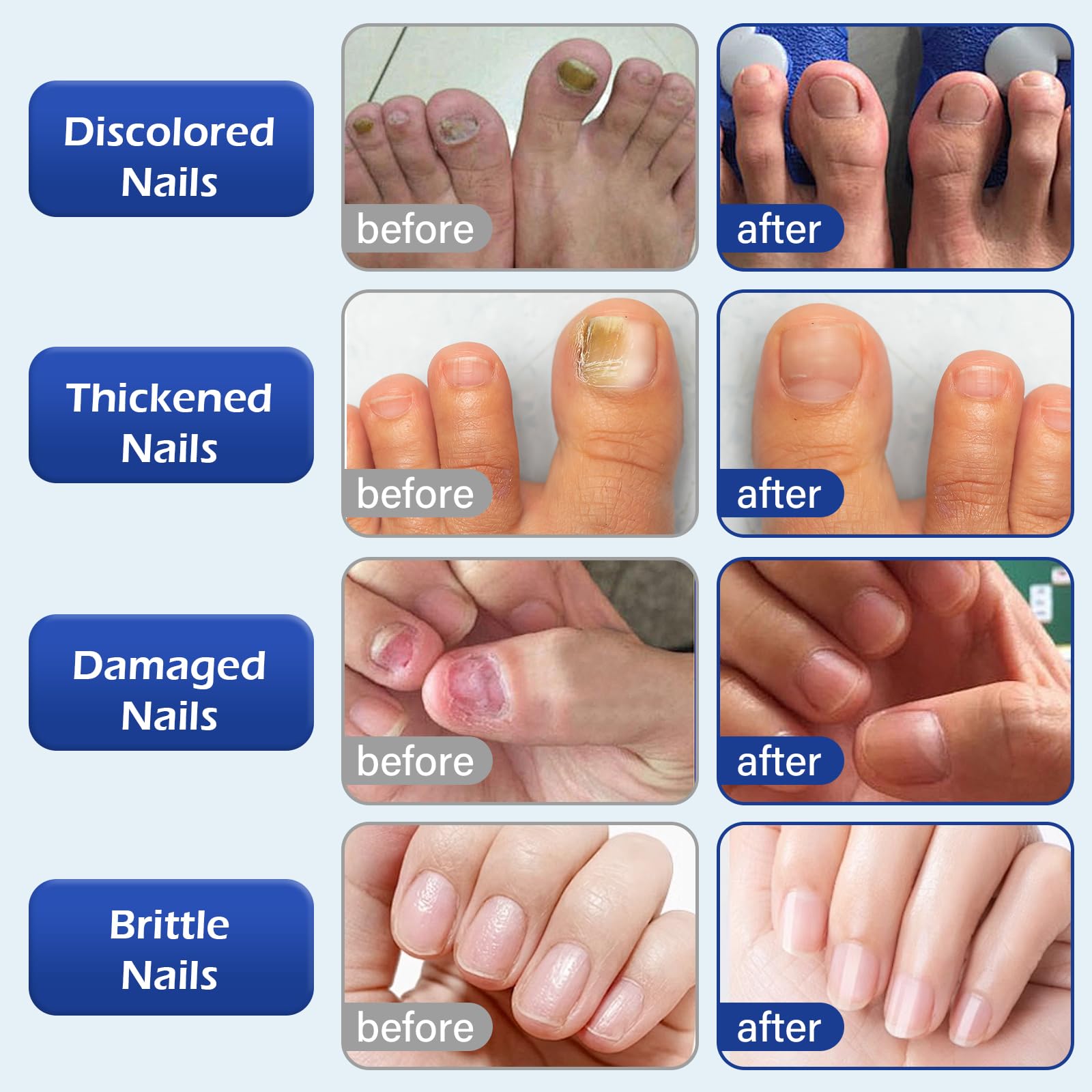 Tea Tree Oil Nail Repair Solution - Strengthen & Restore Discolored, Damaged Nails - Natural Plant-Based Treatment for Healthy Nail Care - Perfect for Salon, Home Use & Travel (1PC)