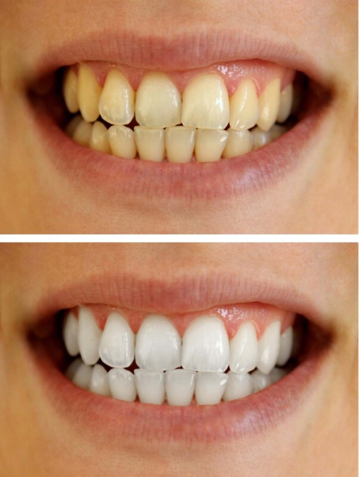 Professional Teeth Whitening Gel with 35% Carbamide Peroxide - Dental Bleaching Syringe Kit (40ml, 4 Pcs) for Brighter Smile at Home | Perfect for Sensitive Teeth & Coffee/Tea Stains Removal
