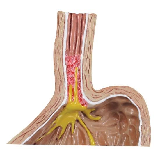 GERD Model - Gastroesophageal Reflux Disease Medical Training Tool for Doctors & Students | Perfect for Medical Education & Clinical Demonstrations