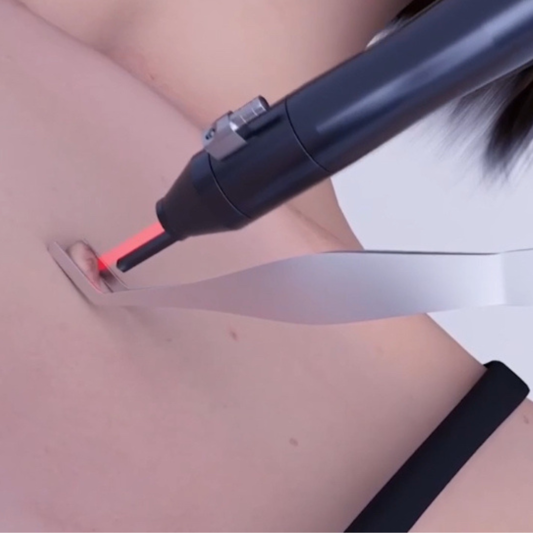 CarbonFrax Pro CO2 Fractional Laser for Skin Resurfacing - Professional Facial Treatment Device for Wrinkle Reduction, Scar Removal & Skin Rejuvenation - Perfect for Dermatologists, Spas & At-Home Skincare