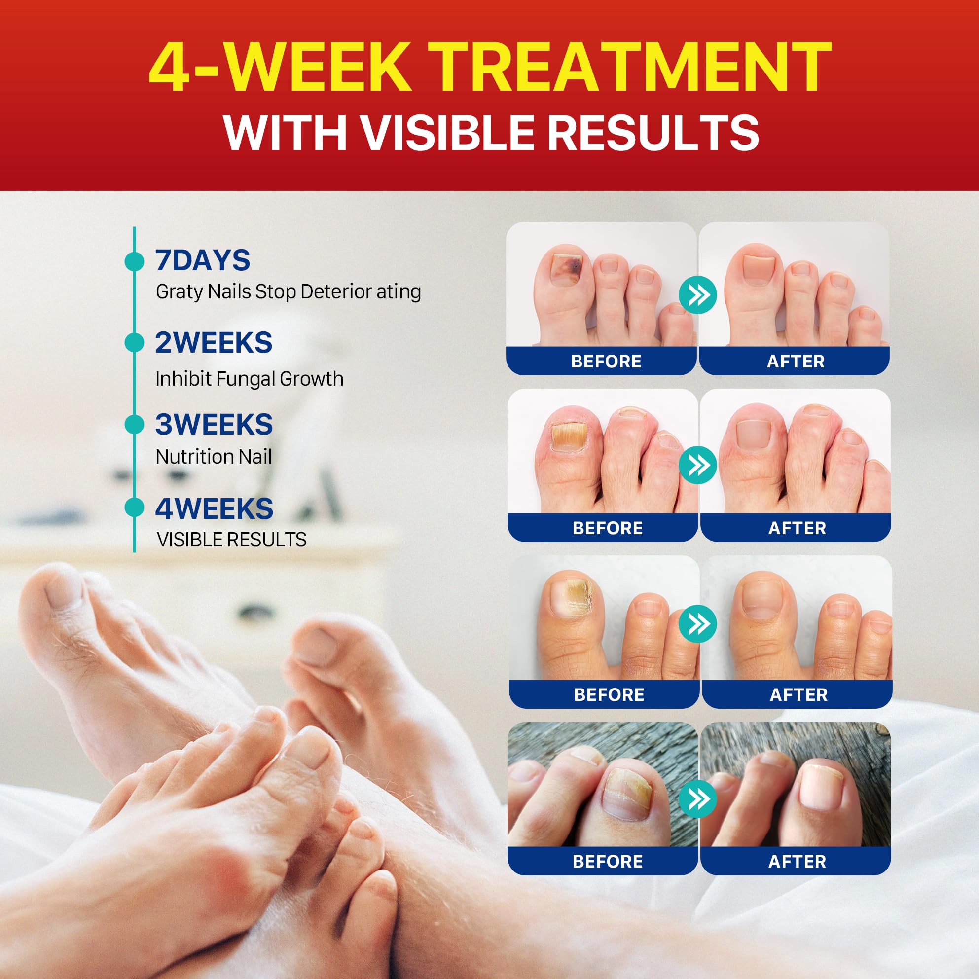 Overnight Nail Repair Patches for Stronger Nails - 32 Medicated Nail Care Patches for Runners, Dancers & Hikers - Perfect for Nighttime Nail Treatment & Recovery After Sports