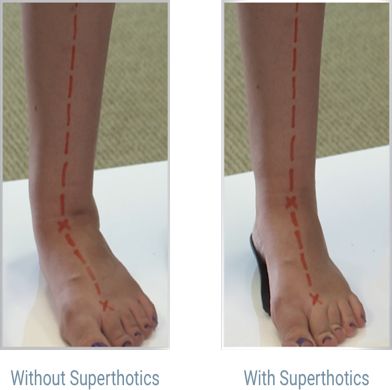 Superthotics - Premium Orthotic Insoles for Foot Pain Relief & Arch Support - Ideal for Running, Walking & Standing All Day