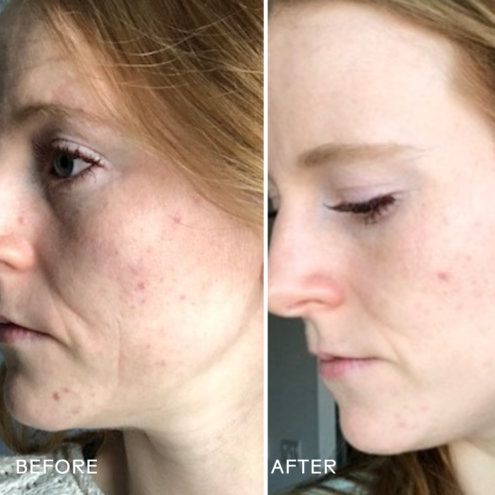Refresh Papaya & Salicylic Acid Face Cleanser - Exfoliating Acne Treatment for Oily & Combination Skin - Daily Deep Pore Cleansing for Clear, Glowing Skin