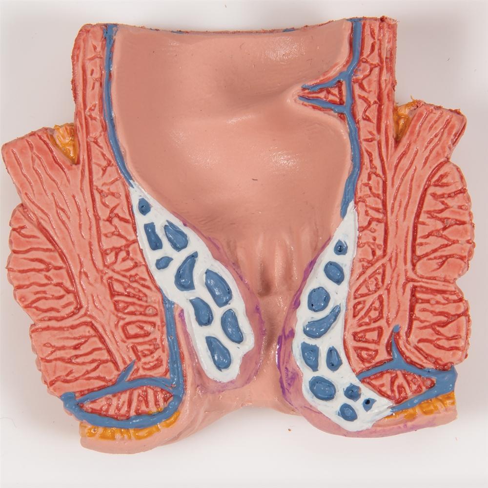 Premium Hemorrhoid Anatomy Model for Medical Training & Patient Education – Ideal for Doctors, Nurses & Healthcare Professionals