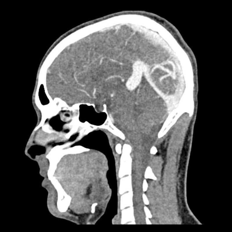 Head and Neck CTA Phantom AVM for CT Scan & X-Ray Training - Medical Imaging Practice, Radiology Education, and Diagnostic Testing