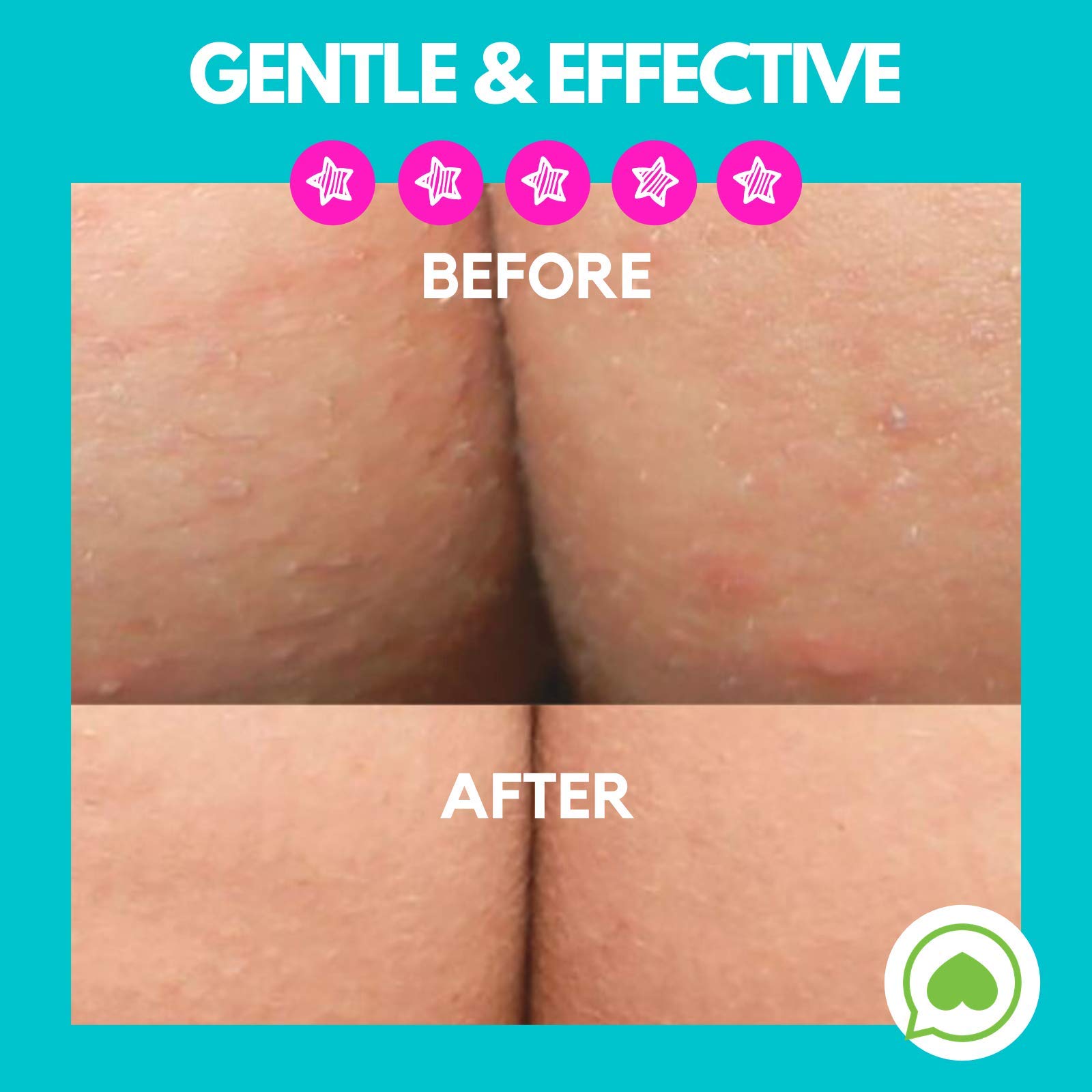 Best Butt Acne Clearing Lotion for Body Breakouts - Fast-Acting Acne Treatment for Back & Bum Pimples - Perfect for Gym-Goers & Active Lifestyles