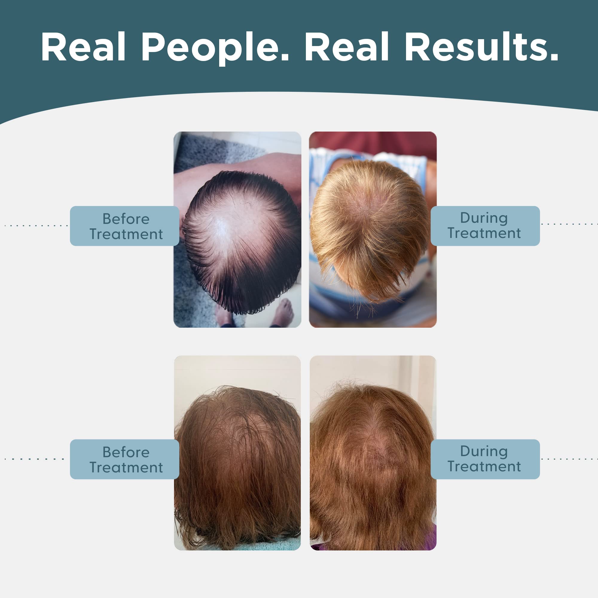 Shapiro MD Minoxidil 5% Hair Growth Solution for Men - Clinically Proven Topical Serum to Reactivate Hair Follicles & Stimulate Regrowth - 2 Month Supply - Ideal for Thinning Hair & Receding Hairline Treatment