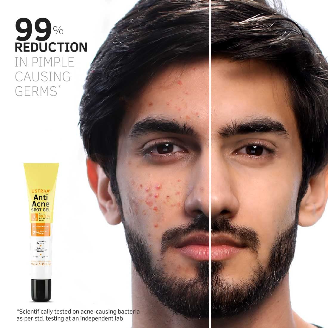 Ustraa Anti-Acne Spot Gel - 15ml | 99.9% Pimple Germ Reduction | 2% Salicylic Acid for Dead Skin & Pore Cleansing | Dermatologist Tested Oil-Free Formula | Reduces Acne & Redness | Perfect for Daily Skincare & Teen Acne Treatment