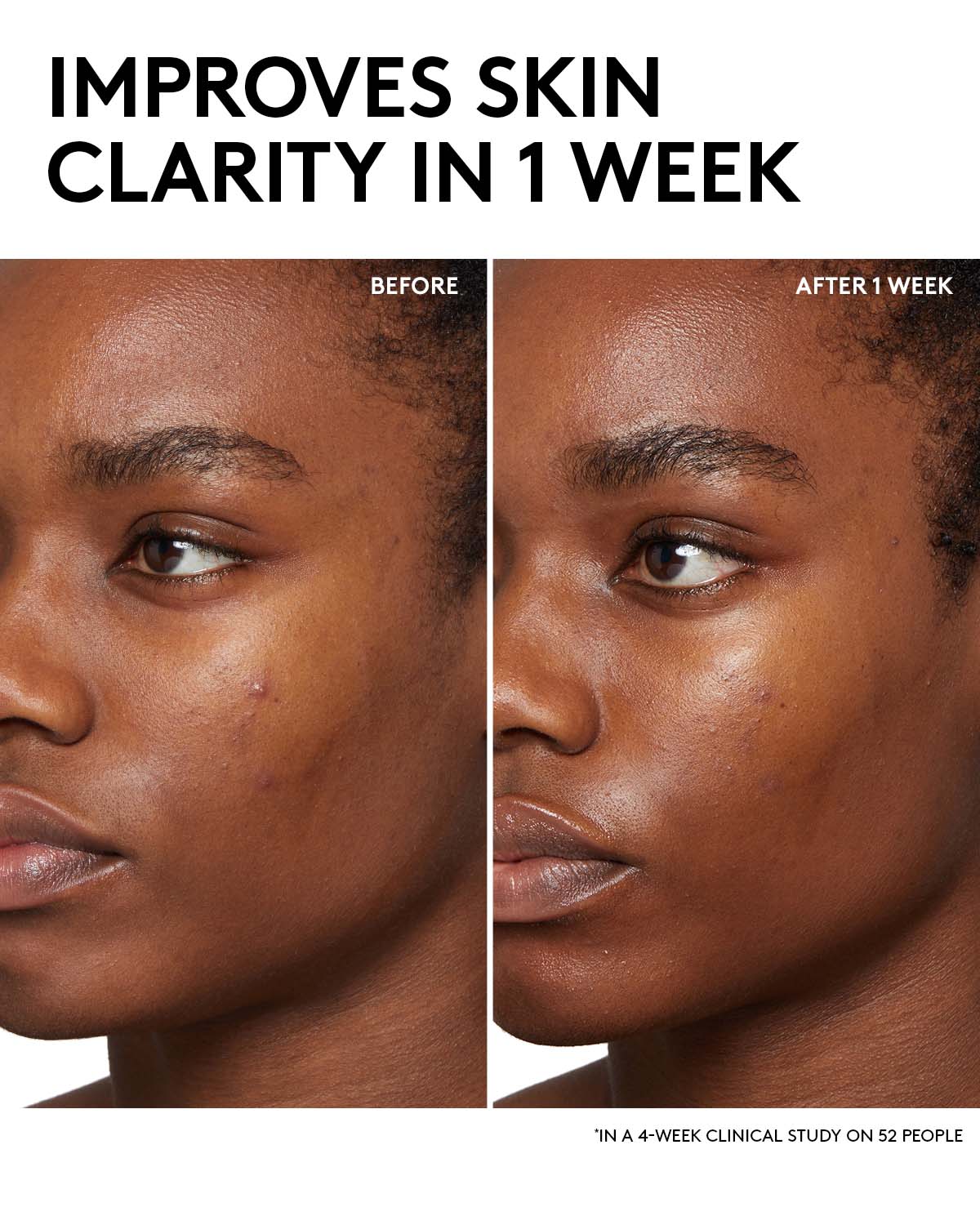 Cherry Dub BHA Toner with 2% Salicylic Acid & Aloe Juice - Exfoliating Face Toner for Acne Prone Skin - Gentle Pore Minimizer for Daily Skincare Routine